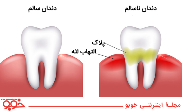 مقایسۀ دندان سالم با دندان ناسالم