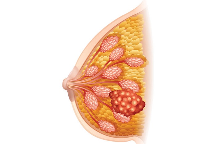 تومور سرطانی سینه