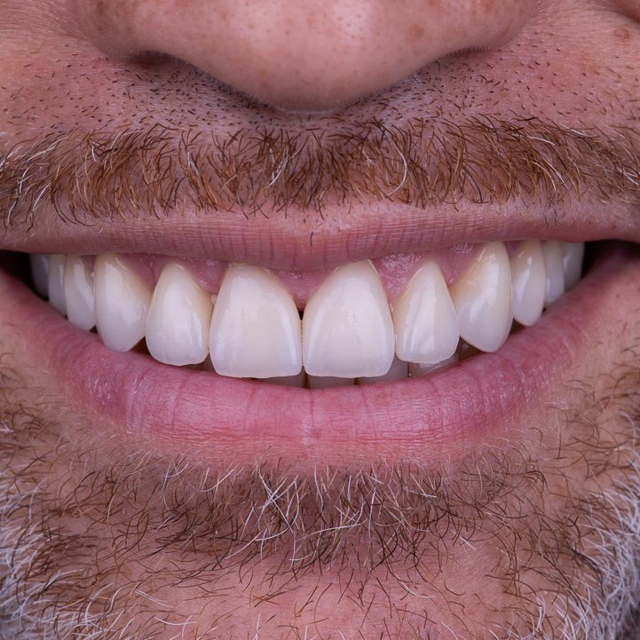 تفاوت لمینت و روکش دندان چیست