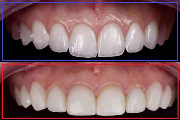 نمونه کار لمینت دندان دکتر فرزانه فرخ نژاد دندانپزشک زیبایی