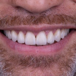 لمینت دندان؛ پاسخ به تمام سوالات احتمالی به زبانی ساده